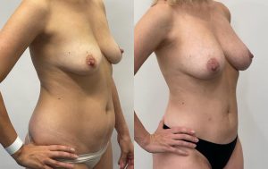 Patient before and after fat trasfer to breast 2-2, Dr Rastogi