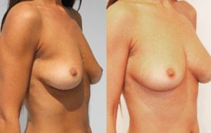 Dr Rastogi, fat transfer to breast surgery results 17-1