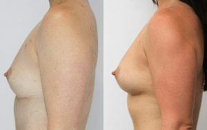 Breast augmentation fat transfer surgery results 19-1, Dr Rastogi Double Bay Sydney