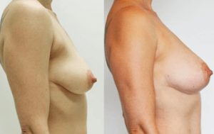 Breast augmentation fat transfer surgery results 19-1, Dr Rastogi Double Bay Sydney