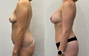 Patient before and after fat trasfer to breast 2-2, Dr Rastogi
