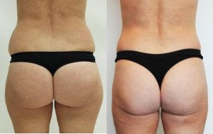 Buttocks lift with liposuction results 9-1, Dr Rastogi