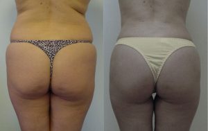 Liposculpture Before and After 01