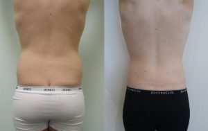 Liposculpture Before and After 02, Dr Rastogi Sydney