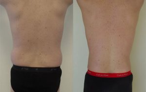 Liposculpture procedure, patient before and after 04