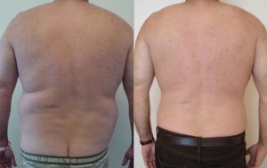 Liposuction before and after 5-1, Dr Rastogi Double Bay Sydney