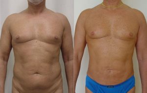 Male liposuction, before and after 5@4x, front view, Dr Rastogi, Doule Bay, Sydney