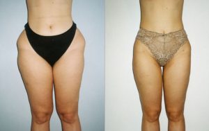 Female liposcution (tummy & thighs), before and after 7-1, Dr Rastogi Double Bay