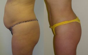 Female liposculpture results 10-1, Dr Rastogi Double Bay Sydney