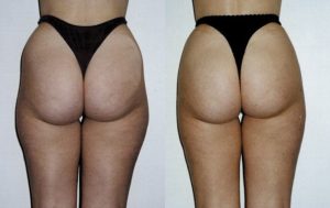 Buttock liposuction before and after 8-1, Dr Rastogi Sydney